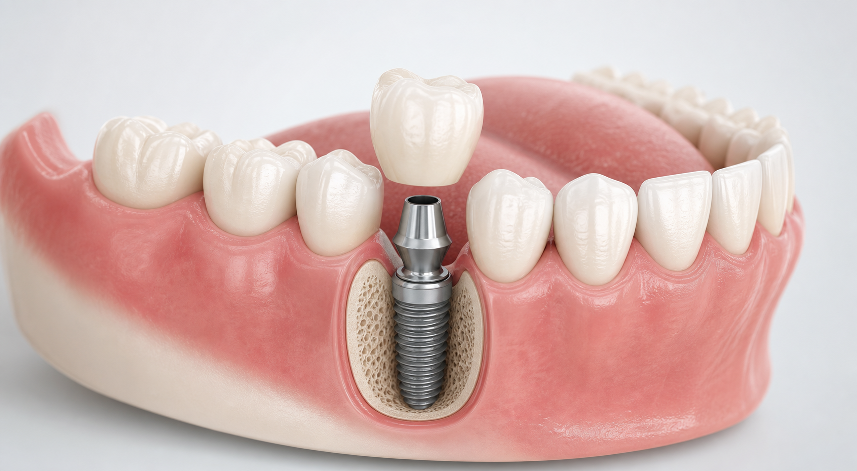 Diş implantı ile ilgili bilinmesi gerekenler