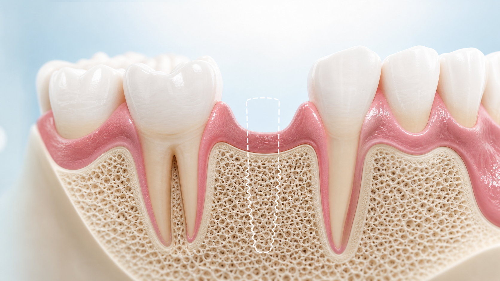 Kimler implant yaptırabilir